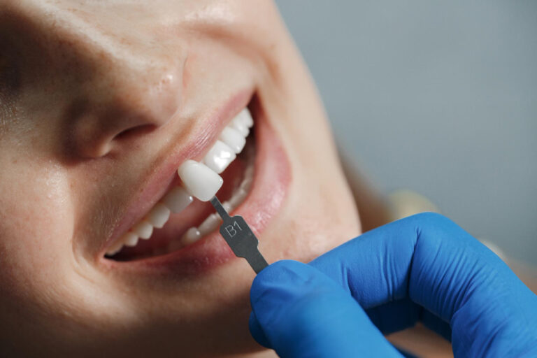 What’s the Process of Getting Porcelain Veneers From Start to Finish?